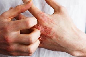 Eczema Injectable Drug Provides Quick Itch Relief, Clinical Trial Results Show